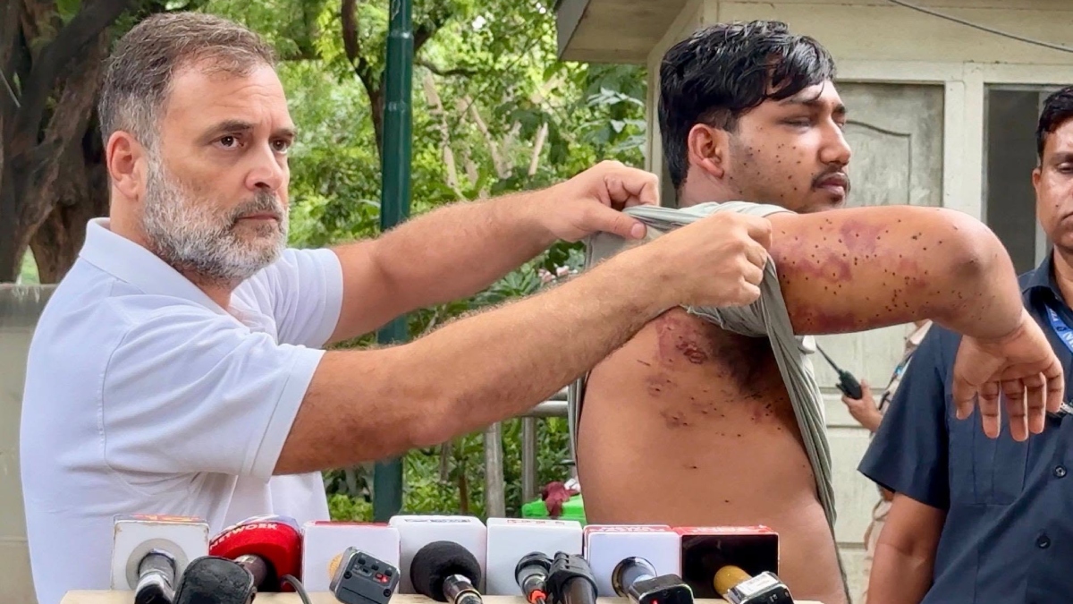 পেলেট গানের গুলিতে আহত এক শিক্ষার্থীর শরীরের ক্ষতচিহ্ন দেখাচ্ছেন রাহুল গান্ধী। ছবি: সংগৃহীত