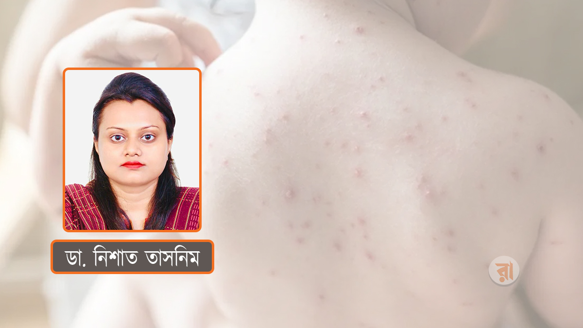 বসন্তে শিশুদের জলবসন্ত: কী করবেন, কী খাওয়াবেন?
