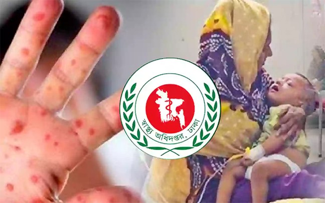 হামের উপসর্গে আরও ৫ শিশুর মৃত্যু